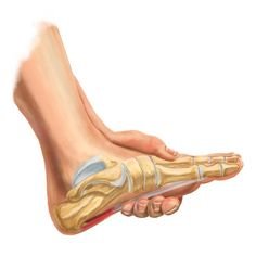 plantar fasciitis medical devices