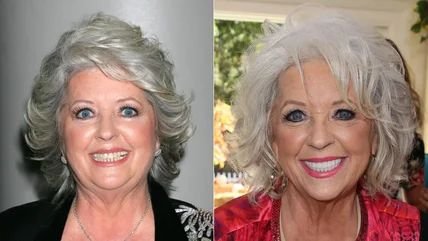 What is Plastic surgeons Ozempic face