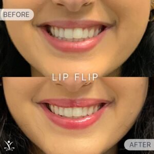 Lip Flip Before and After Smile