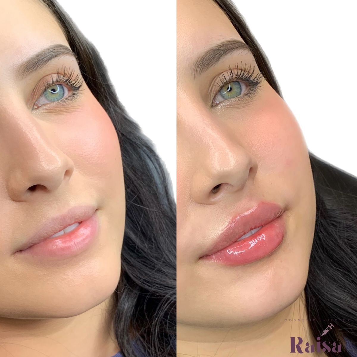 lip flip before and after